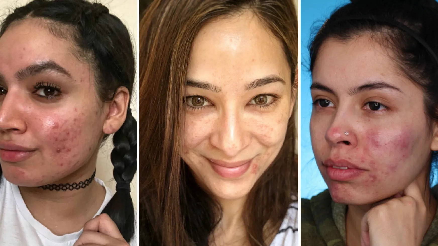 The Cute Identification Of Flaws And How Acne Acceptance Is Reshaping Social Beauty Standards